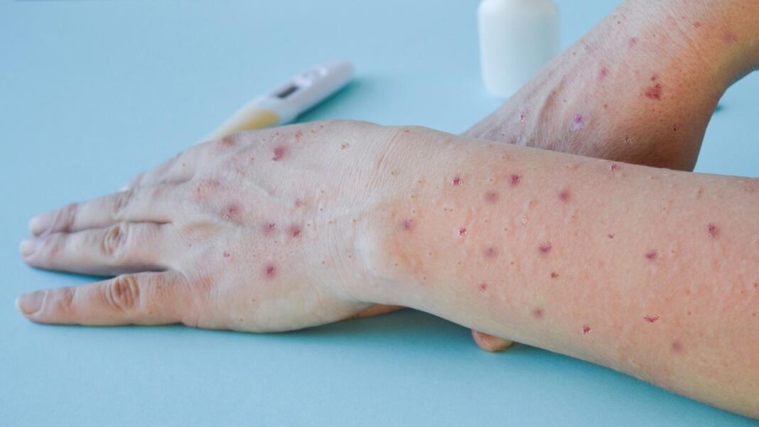 Seremi-de-Salud-confirma-primer-caso-de-Mpox-en-Nuble-este-2025-1068x601
